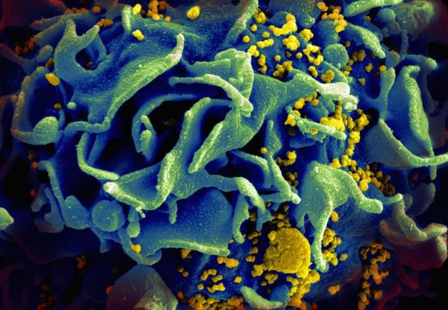 Scanning electromicrograph of an HIV-infected T cell (NIAID, Flickr).