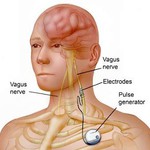 Vagus nerve stimulation (VNS). Photo credit: Mayo clinic health library.